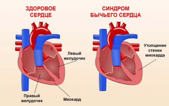 Стенка левого желудочка. Бычье сердце заболевание. Бычье сердце патология. Бычье сердце диагноз у человека что это такое.