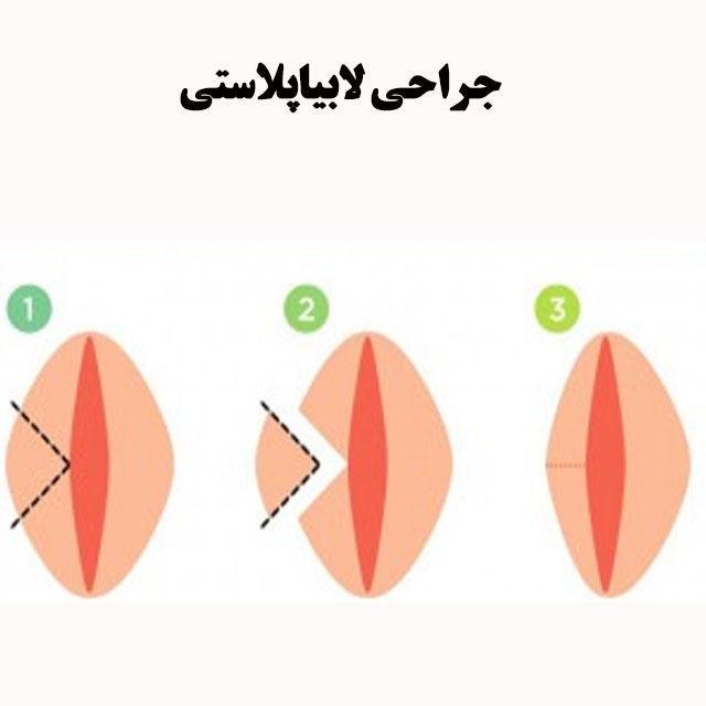 Виды женских половых. Малые половые губы лабиопластика. Лабиопластика пластика половых больших губ. Лабиопластика гипертрофия. Лабиопластика больших и малых половых губ.