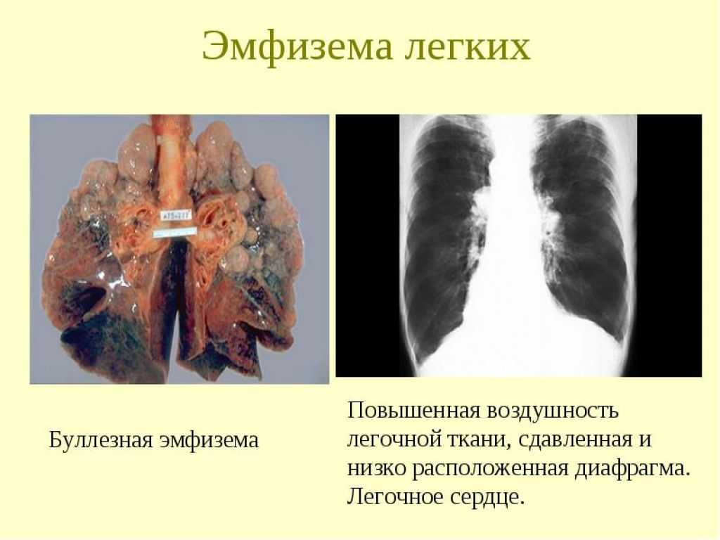 Диффузный рак легких. Внутридольковая эмфизема. Заболевание буллезная эмфизема. Периацинарная эмфизема. Экспираторная эмфизема.