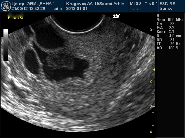 Эндометрий на узи. Кисты эндометрия матки на УЗИ.