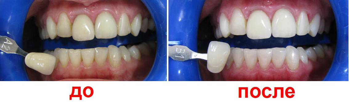 Отбеливание Зубов Недорого Москва К31