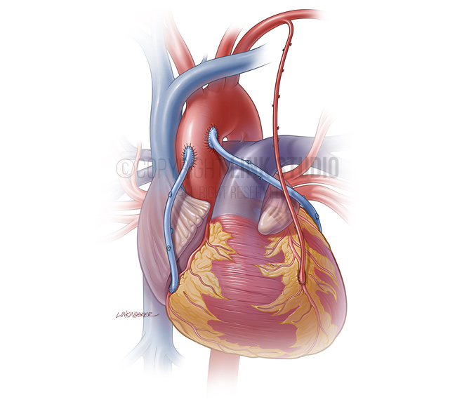 Шунтирование сосудов сердца. Аорта коронарное шунтирование. Аортокоронарное шунтирование ход операции. Шунтирование клапана сердца.