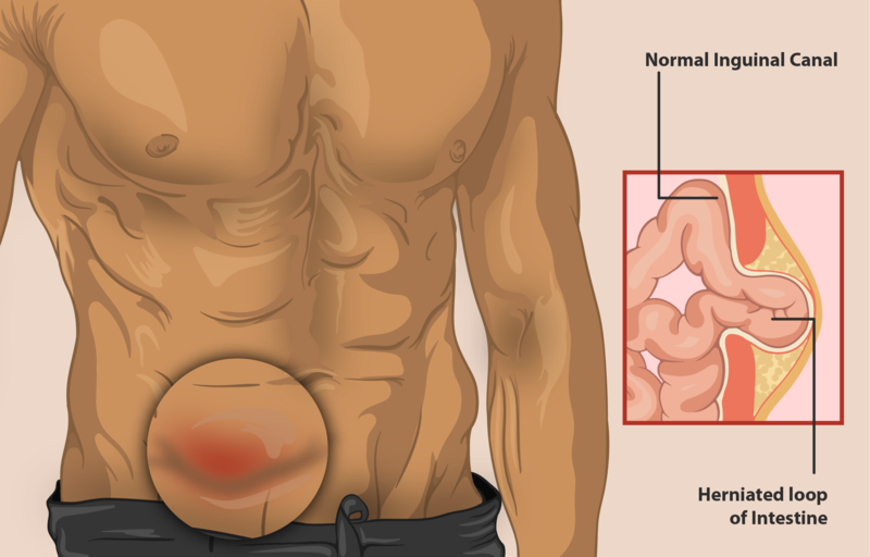 UHB;F. Боль в яичках у мужчин лечение