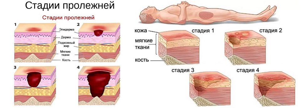 Размер пролежня