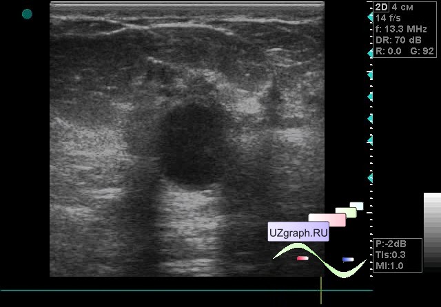 Узи молочных желез у детей. Образования молочных желез на УЗИ.