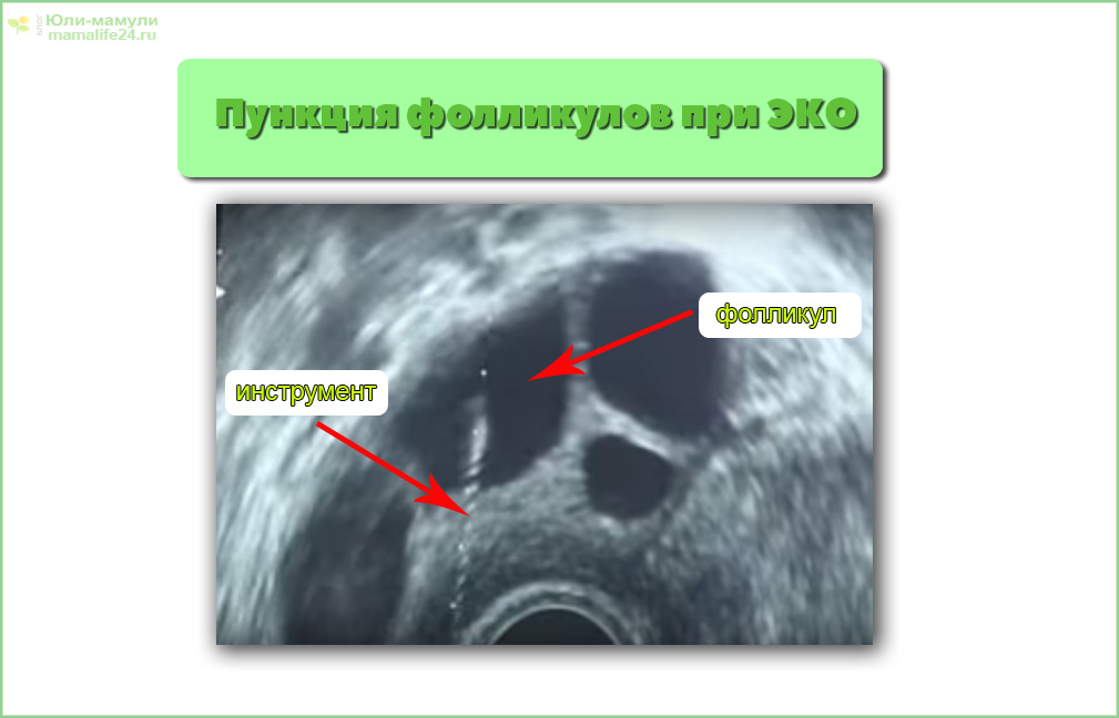 Пункция яичников при эко. После пункции фолликулов. Пункция фолликулов яичника. УЗИ после пункции фолликулов. Пункция фолликулов при эко.