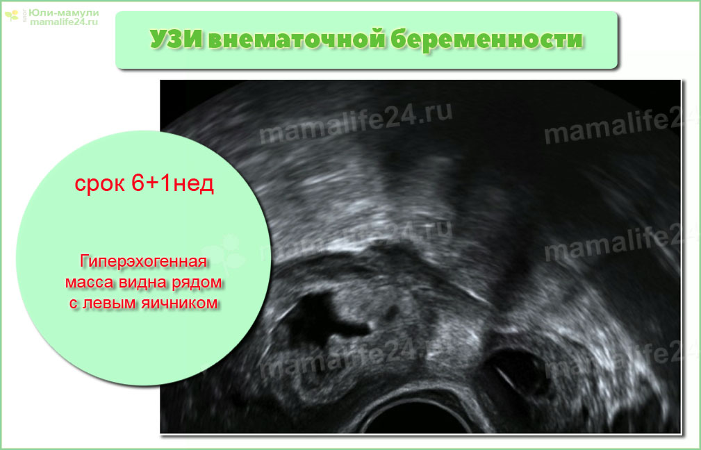 Тест после внематочной. Внематочная беременность на УЗИ. УЗИ внематочной беременности на раннем сроке. Трубная беременность УЗИ. Внематочную беременность видно на УЗИ.