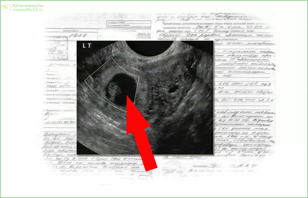 Внематочная беременность на ранних сроках