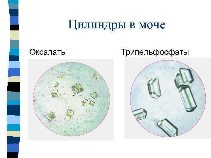 Соли в моче у ребенка