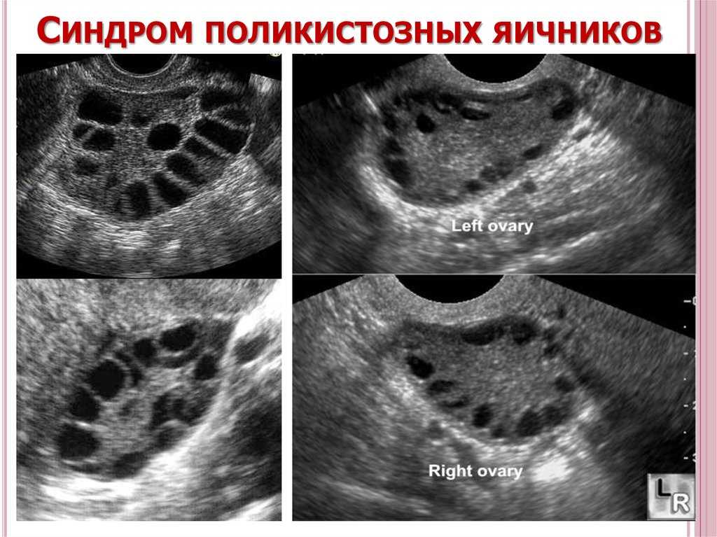 Мультифолликулярные яичники фото