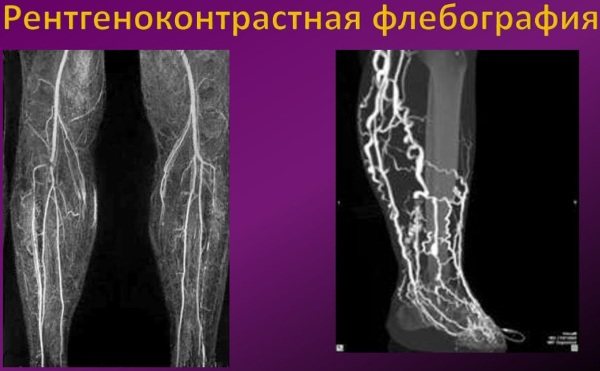 Флебография вен нижних. Кт флебография нижних конечностей. Кт-ангиография артерий нижних конечностей. Флебография вен нижних конечностей. Флебография вен нижних конечностей варикоз.