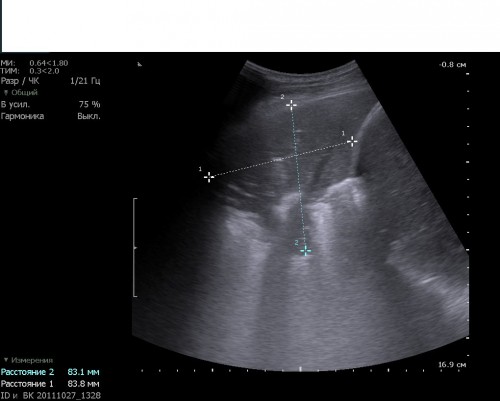 Жидкость в плевральной полости на узи фото