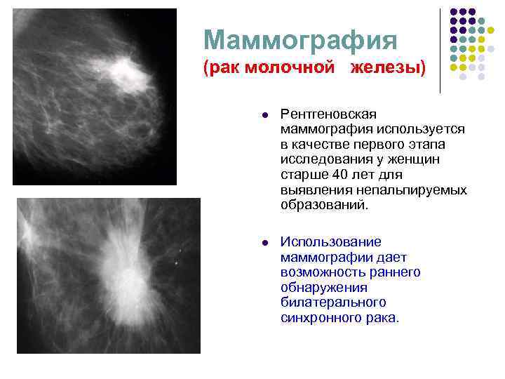 Что такое фиброаденоз молочной железы. Маммография молочных желез РМЖ. Рик молочной железы маммографич. Онкология на маммографии. Рентгеновская маммография.