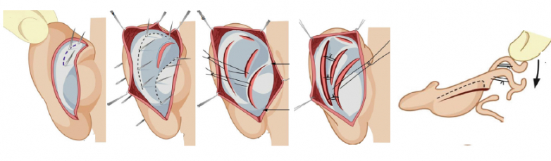 Пластика Уха Фото