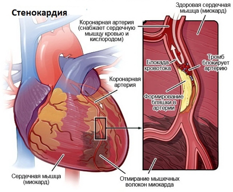 Грудная жаба фото