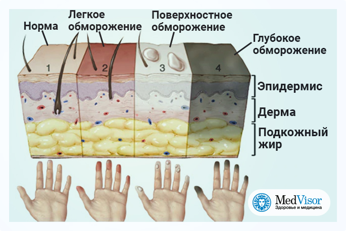 Холодные кожные покровы. Легкая степень обморожения. Отморожение кожи степени. Стадия обморожения волдыри.