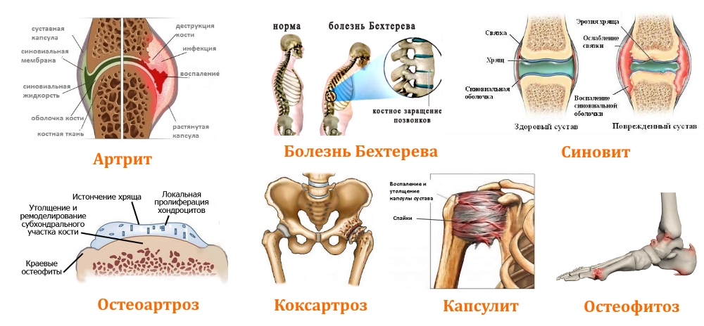 Диагноз суставы. Болезнь Бехтерева и ревматоидный артрит. Ревматоидный артрит поражение позвоночника. Поражение позвоночника при ревматоидном артрите. Ревматоидный артрит с2 позвонка.