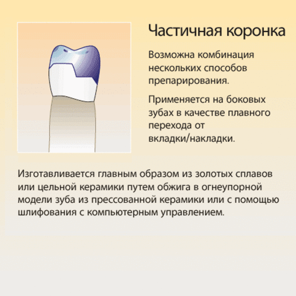 Выпал что делать. Керамические коронки и вкладки. Полукоронки коронки зубы.