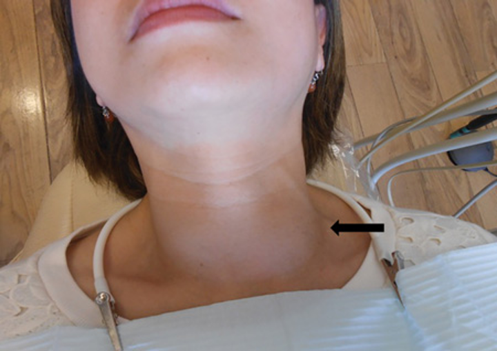 Зоб щитовидной железы операция. Лимфоузлы на шее и щитовидная железа. Шрам после операции на щитовидной железе. Припухлость щитовидки. Лимфоузлы на щитовидке