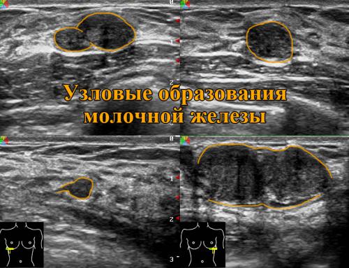 Ультразвуковое Исследование Молочных Желез Цена К31