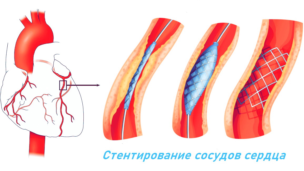 Схема стентирования сосудов сердца