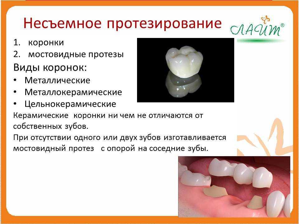 Фото коронок на зубы какие бывают