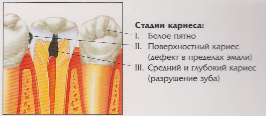 Стадии кариеса. Межзубной кариес жевательных зубов. Межзубный кариес верхних молочных резцов. Кариес в форме белого пятна.