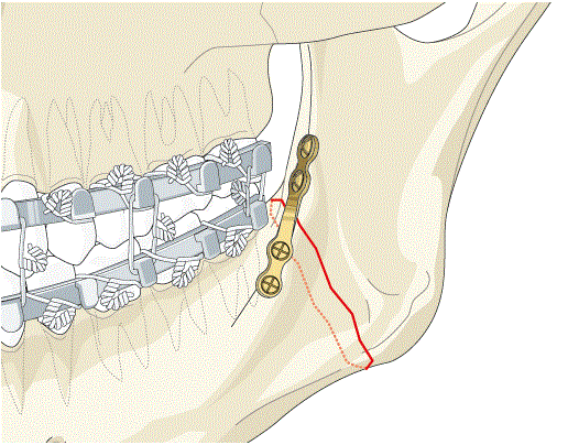 Перелом нижней челюсти пластина. Остеосинтез переломов нижней челюсти минипластинами. Остеосинтез перелома челюсти. Минипластины для остеосинтеза челюсти. Остеосинтез титановыми пластинами нижней челюсти.
