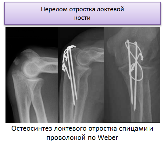 Операция перелом локтевого отростка. Остеосинтез перелома локтевого отростка по Веберу. Остеосинтез локтевого отростка по Веберу рентген. Остеосинтез локтевой кости по Веберу. Перелом локтевого отростка остеосинтез.