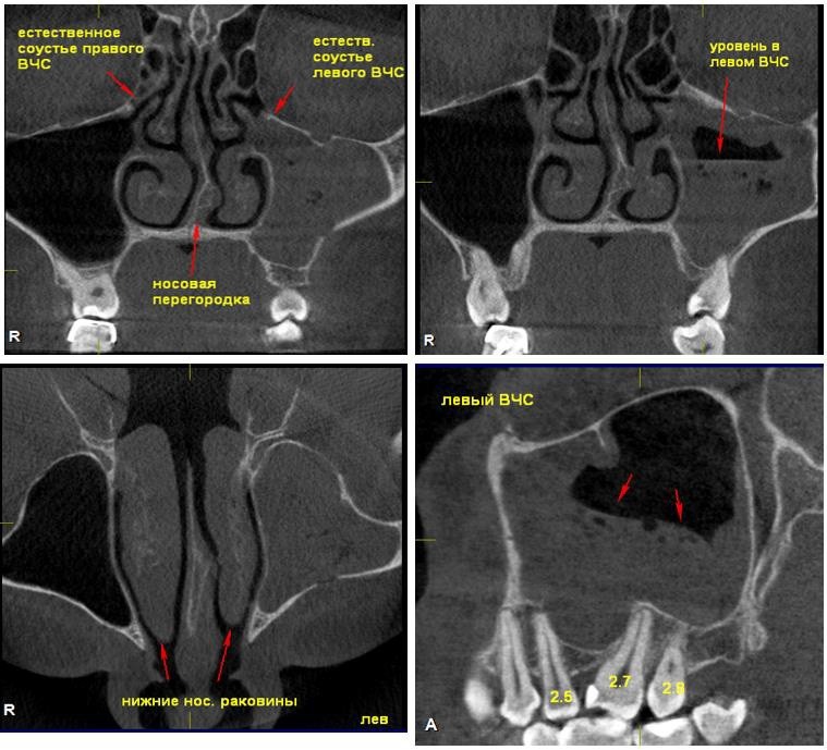 Соустье. Соустье гайморовой пазухи на кт. Верхнечелюстное соустье.