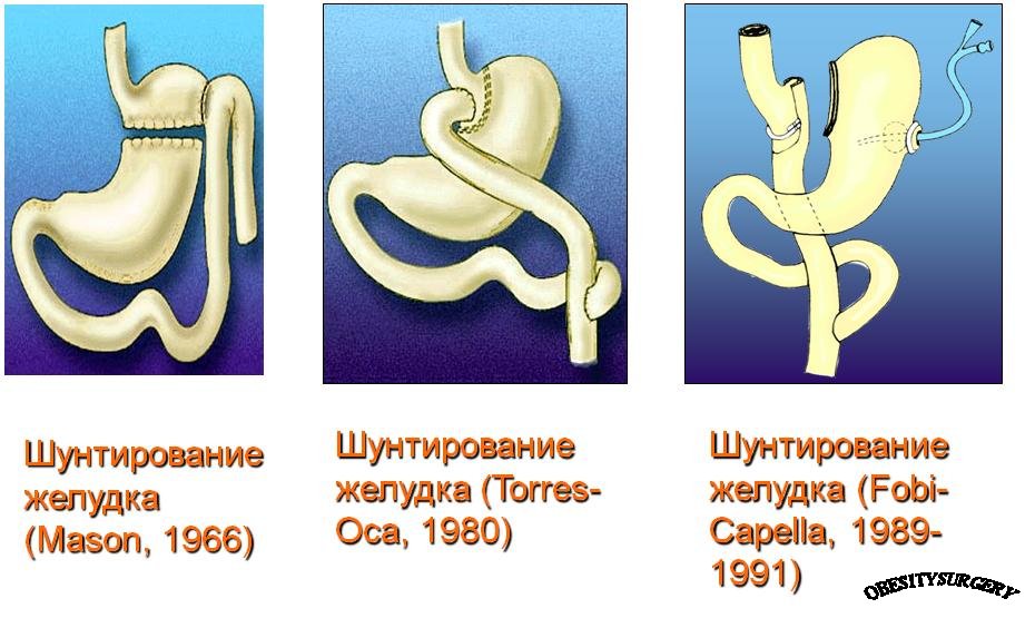 Что такое резекция желудка для похудения