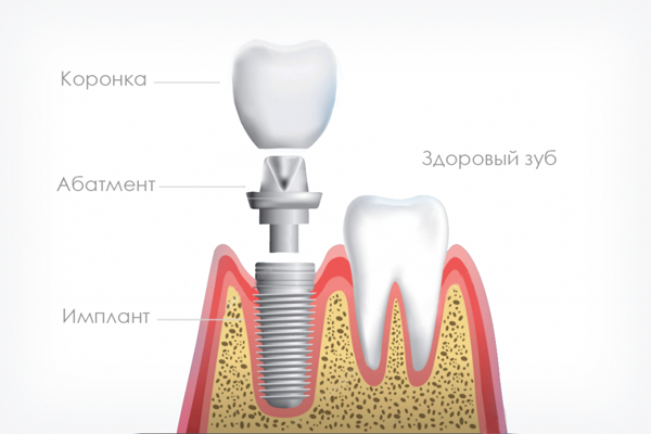 Абатмент на имплант. Абатмент в стоматологии. Как выглядит абатмент импланта. Передняя направляющая в стоматологии.