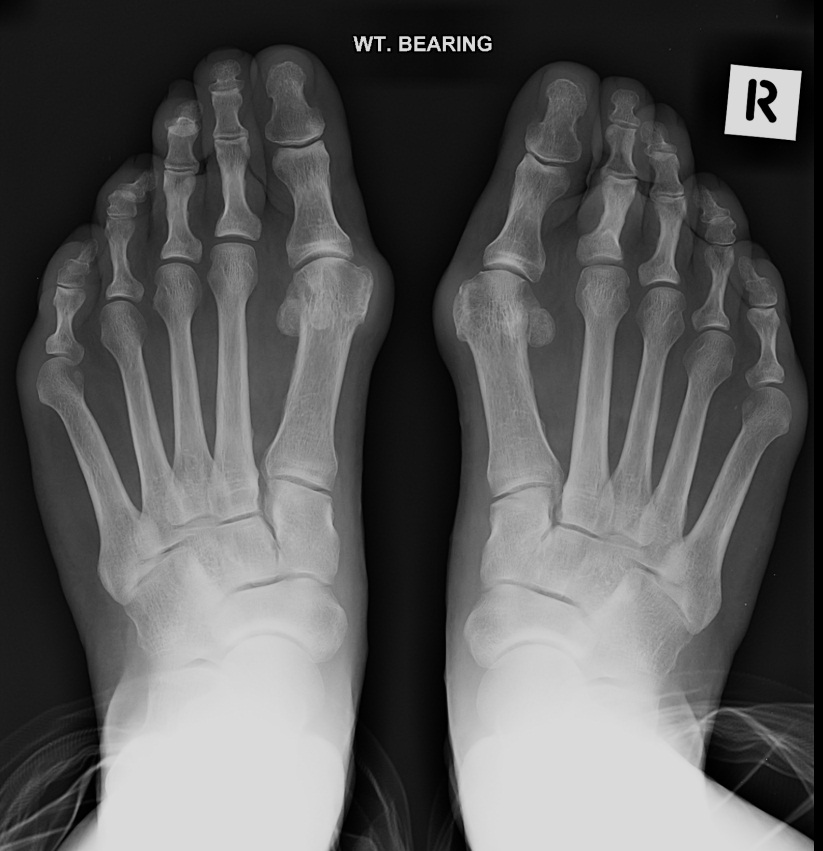 Стопа рентген. Hallux valgus степени рентген. Халюкс вальгус рентген. Варусная деформация стопы рентген. Халюс вальгус 2ст рентген.