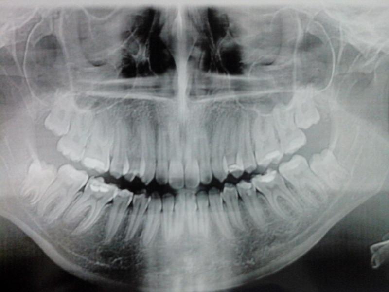 Рентген челюсти