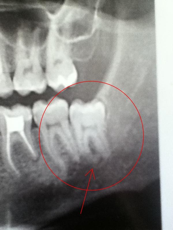 Зубы восьмерки это какие. Ретинированный зуб мудрости. Ретинированный зуб мудрости рентген.