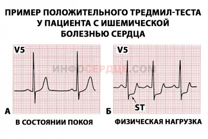 Подготовка к тредмил тесту