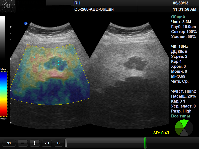 УЗИ И фиброэластометрия печени. УЗИ эластография печени. Эластография цирроз печени. УЗИ печени с эластометрией.