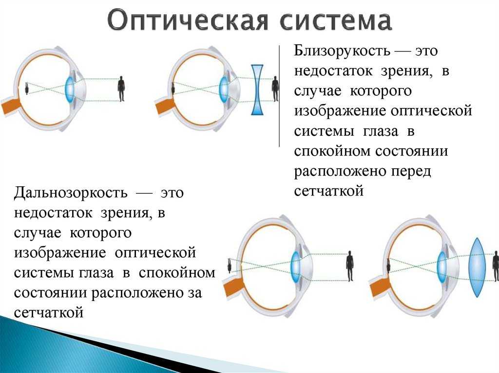 Дефекты зрения физика кратко. Оптическая система глаза при близорукости. Зрительная система дальнозоркость. Близорукость (истинная и ложная формы патологии). Оптическое строение глаза.