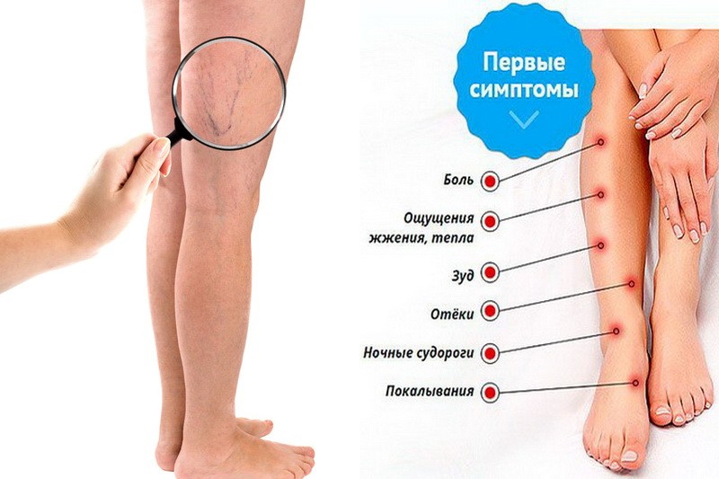 Вены внизу ноги. Профилактика варикозного расширения вен. Расширение вен симптомы. Расширение вен на ногах симптомы.