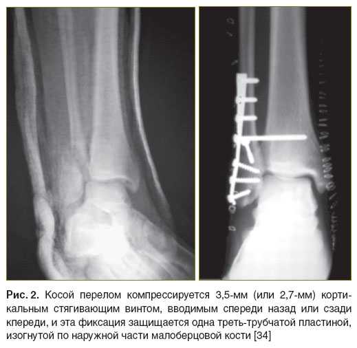 Нужно ли снимать пластины. Экстрамедуллярный остеосинтез лодыжки. Голеностопный сустав перелом малоберцовой кости. Остеосинтез двухлодыжечный перелом. Абдукционный перелом лодыжки.