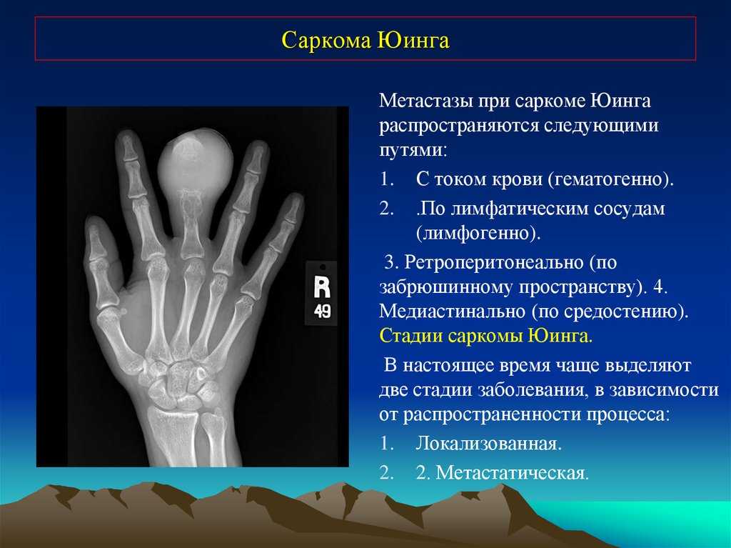 Саркомы мягких тканей презентация