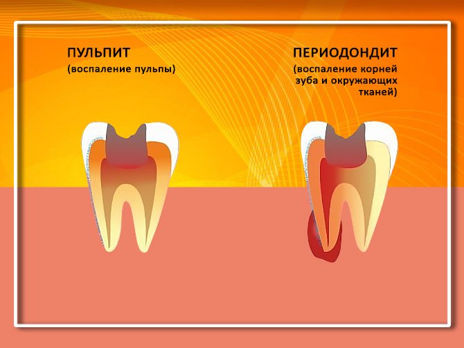 Удаление зуба какие таблетки пить. Воспаление зубов и десен. Воспаление десны в корне зуба. Антибиотики привоспалентт зуба.
