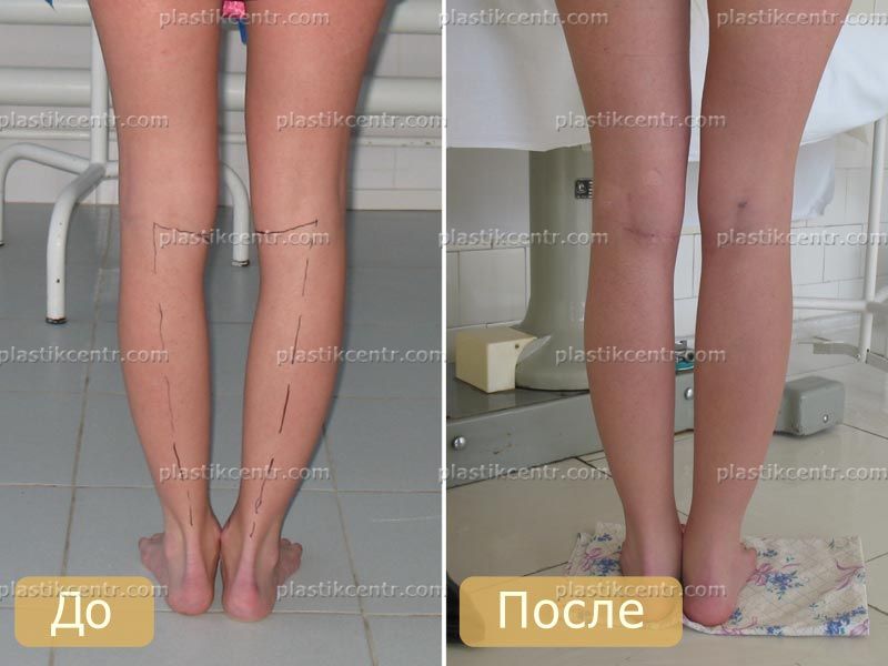 Липосакция голени до и после фото
