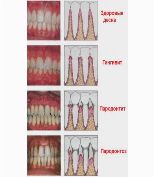 Этиология пародонтита