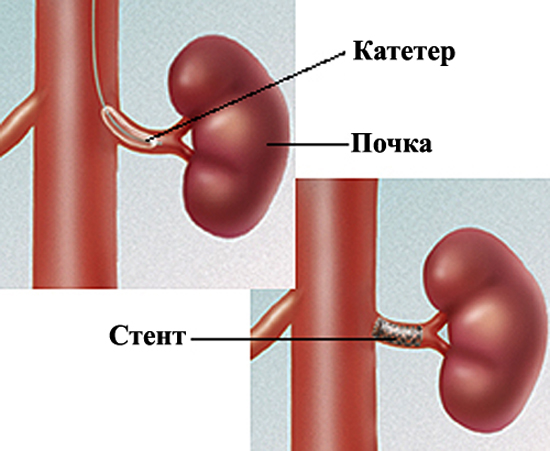Установка стенда в мочеточник. Стент в почке и мочеточнике. Стентирование почечной артерии. Стенд катетер для мочеточника.