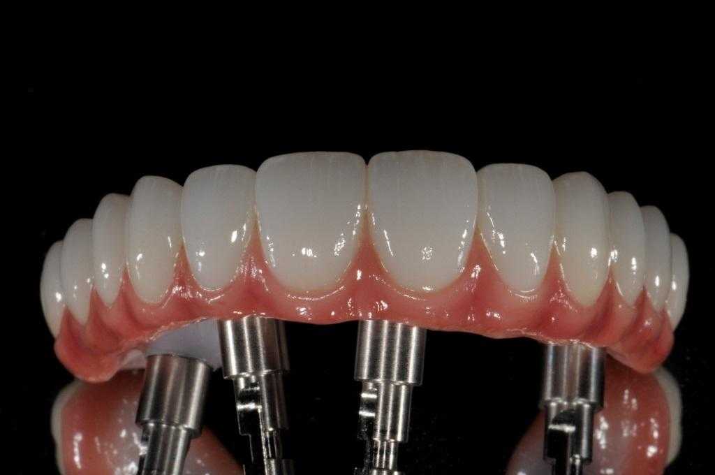 Мост на имплантах на 4 зуба фото