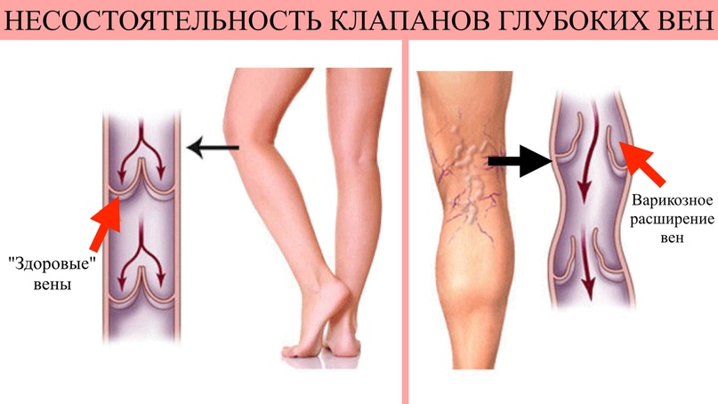 Мышцы вены. Варикоз икроножная мышца. Эффект мышечно-венозной помпы нижней конечности. Икроножные вены голени.