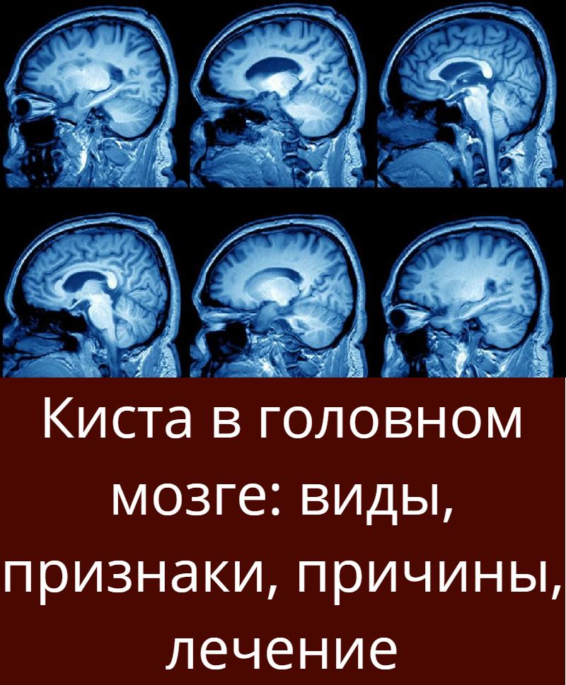 Постишемические кисты мозга. Локализация кист головного мозга. Лекарство от кисты головного мозга. Киста в головном мозге у взрослого симптомы.