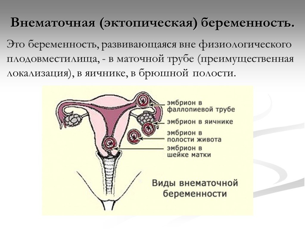 Риск внематочной беременности. Внематочная беременность со спиралью. Внематочная (эктопическая) беременность. Локализация внематочной беременности. Профилактика внематочной беременности.