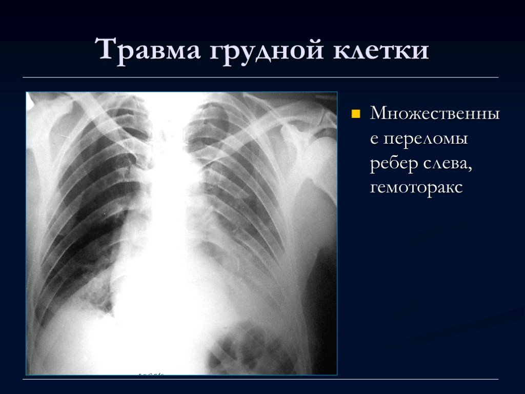 Травмы грудной клетки презентация